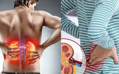 Kidney Stones Support